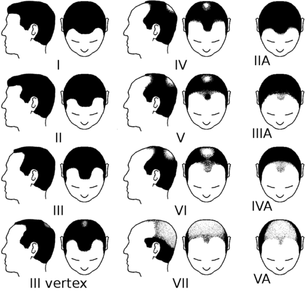 Hair loss infographic