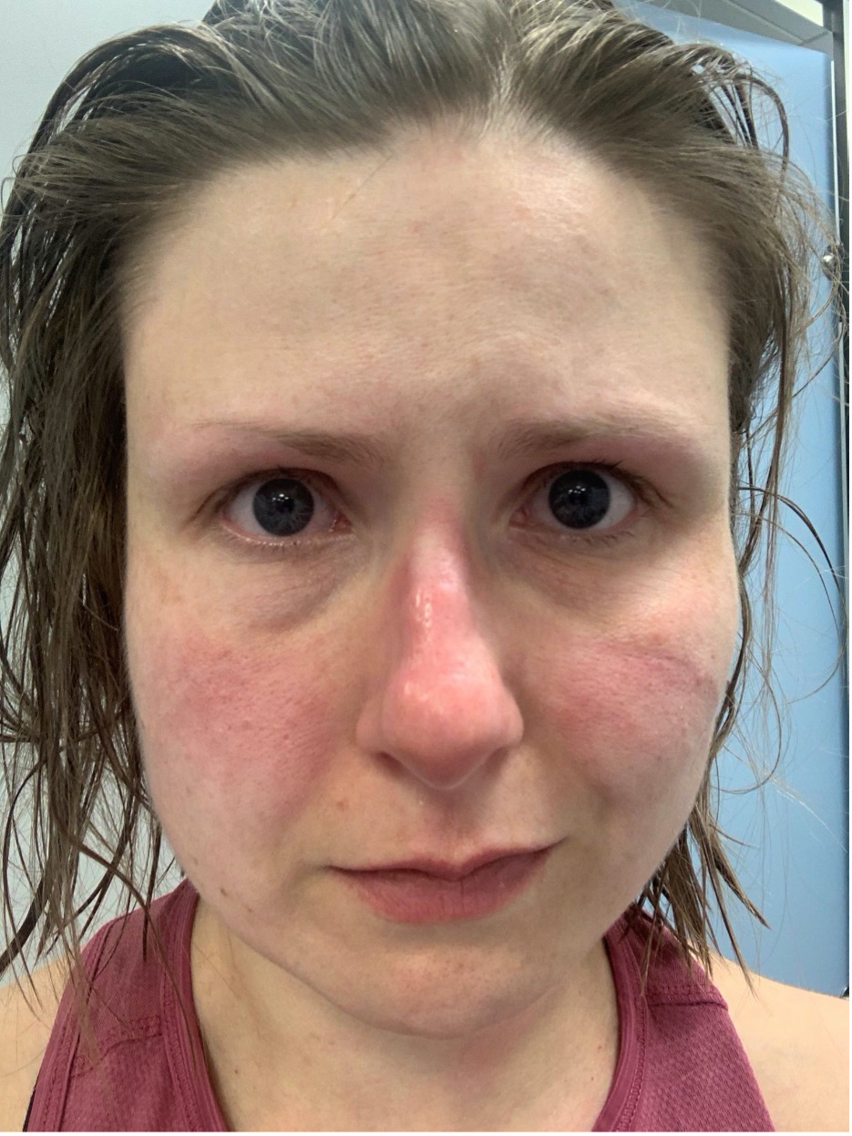 Photo shows the marks left after using PPE.