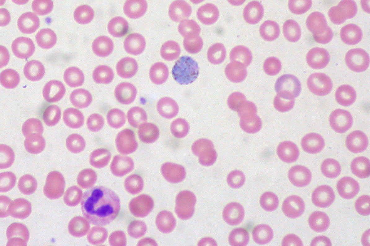 Plasmodium vivax, one of the malaria causing parasites, in a blood sample. Ed Uthman @ Flickr