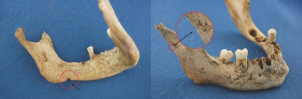 JFJ mandible